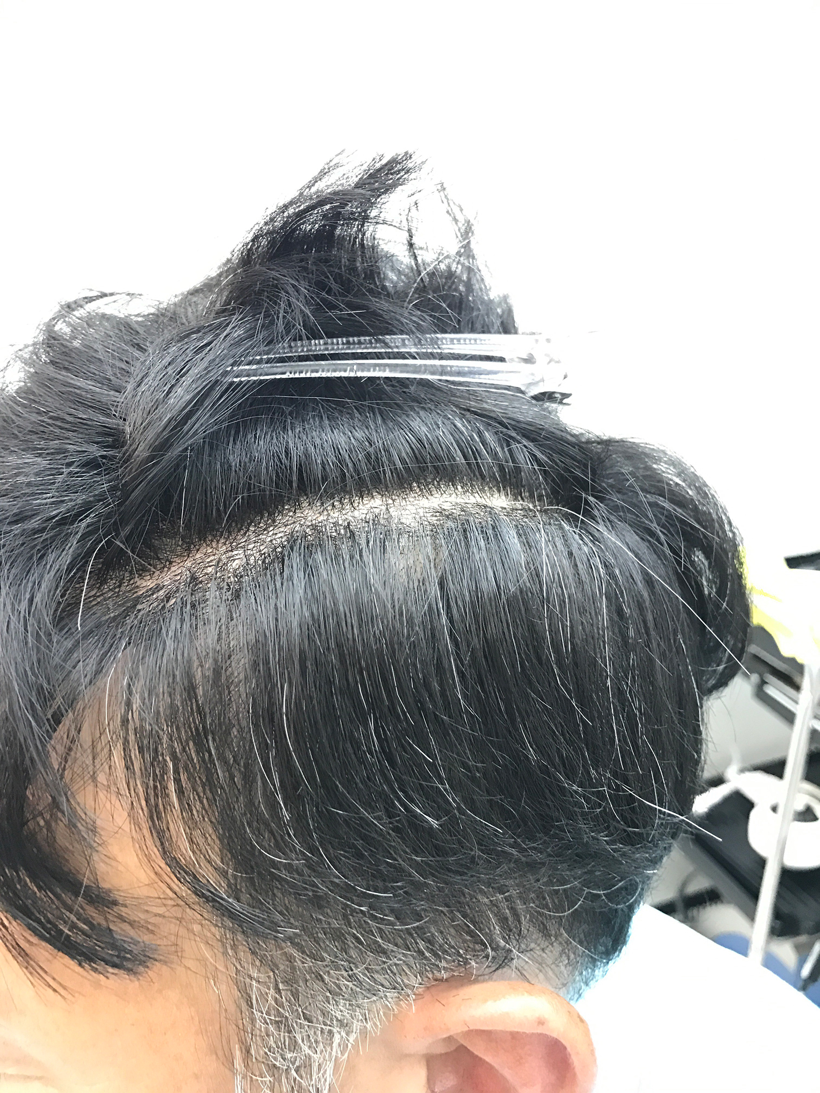 ヘアコンタクトの装着から仕上がりまで全部見せます。 | PROPIASTYLE プロピアスタイル～髪の悩みを新しい希望へ～