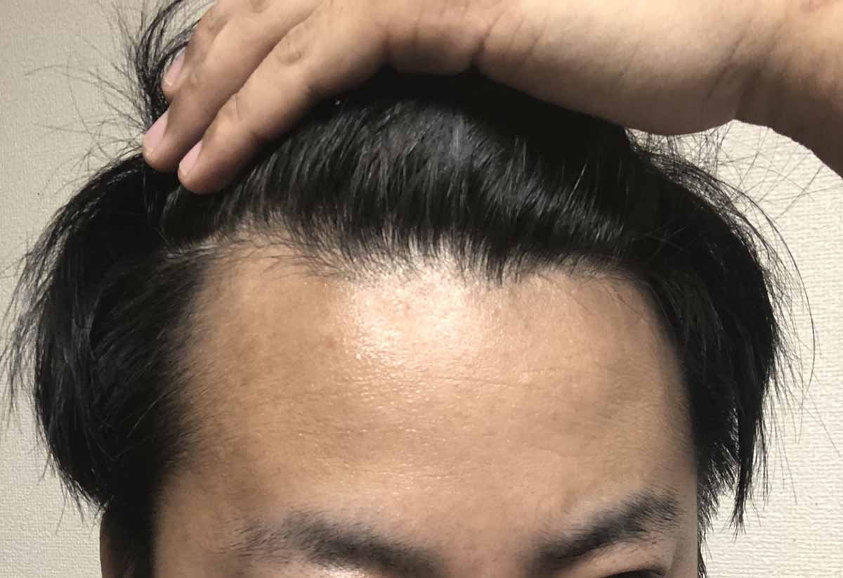 M字が気になる方必見！ヘアコンタクト体験してみました