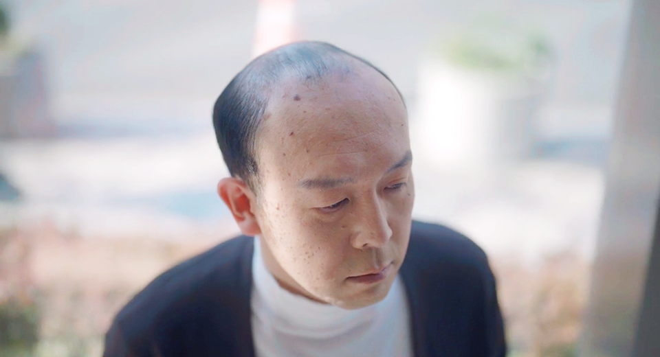 ミライズを着用する前の男性の写真。薄毛で髪の毛にボリュームがない様子。